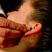 Acupuncure in addiction: smoker's ear stud