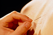 Acupuncture to reduce aggressive energy