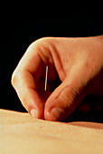 Acupuncture to reduce 'aggressive energy'