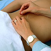 Acupuncture needles placed in lower back