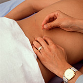 Acupuncturist treating patients back