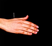 Hand with inserted acupuncture needle