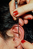 Acupuncure in ear to cure cigarette addiction