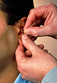 Acupuncturist's hands insert needle into man's ear