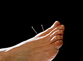 Acupuncture needles in a woman's foot