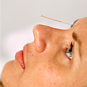 Facial acupuncture
