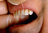 Close-up of a man flossing his teeth