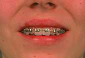 Fixed braces on the teeth of a 13-year-old girl