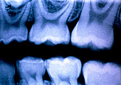 X-ray of a child's healthy molar teeth