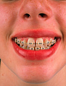 Girl with fixed brace on her teeth