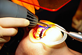 Orthodontic brace fitting