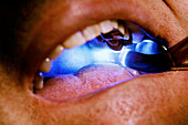 Dental treatment