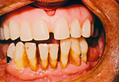 Close-up gums & teeth showing periodontal disease