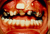 Close-up of mouth showing decay of milk teeth
