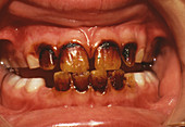 Close-up of a person's teeth showing dental plaque