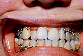 Wired teeth aim to cure obesity