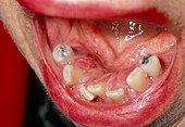 Close-up of swollen and inflamed gums (gingivitis)
