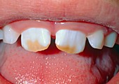 Brown staining of child's teeth due to fluorosis