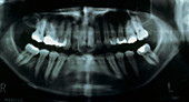 Pan-oral X-ray showing teeth with fillings