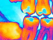 Coloured X-ray of an impacted wisdom tooth