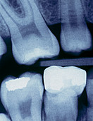 X-ray of child's teeth with fillings and a crown