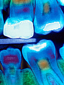 Colour X-ray of child's teeth with fillin