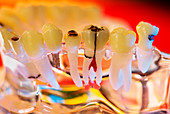 Tooth decay and implants,dental model