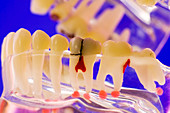 Tooth disorders,dental model