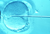 ICSI method of in vitro fertilization