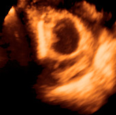 Pregnancy with IUD,ultrasound scan
