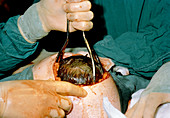 Caesarian section; baby's head emerging