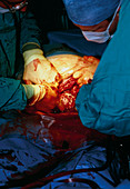 Surgeons carrying out a caesarean section birth