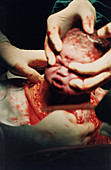 Caesarean section