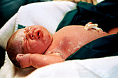 Newborn baby after Caesarean