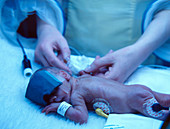Premature baby undergoing treatment for jaundice