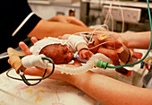 Premature baby girl in neonatal unit