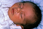Face of newborn baby with jaundice