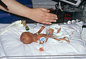 Premature baby with nurse's hand to indicate size