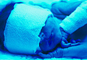 Premature baby with jaundice having phototherapy