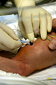 Nurse removing an umbilical catheter