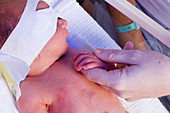 Premature baby receiving phototherapy