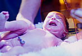 Neonatal jaundice treatment