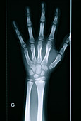 Delayed bone age,X-ray