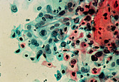 LM of a cervical smear showing moderate dysplasia