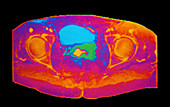 False-colour MRI of female pelvis: cervical cancer