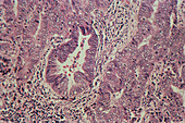LM showing human endometrial adenocarcinoma