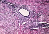 LM showing adenomyosis of human uterus