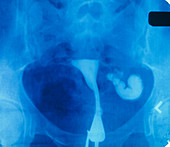 Infertility: hysterosalpingogram of blocked tubes