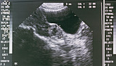 Ultrasound image showing an ectopic pregnancy
