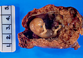 Excised fallopian tube with an ectopic pregnancy